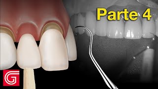 Cómo probar las coronas de zirconia antes de la cementación final – Parte 4 [upl. by Elatia316]