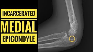 Incarcerated Medial EpicondyleHow to Diagnose [upl. by Ethyl]