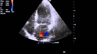 clear view of ischemic dilated cardiomyopathy with MR [upl. by Ennailuj]