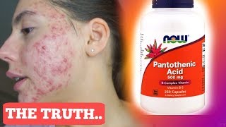 I TOOK PANTOTHENIC ACID FOR ONE MONTH STRAIGHT  THIS IS WHAT ACTUALLY HAPPENED TO MY ACNE [upl. by Gentille]