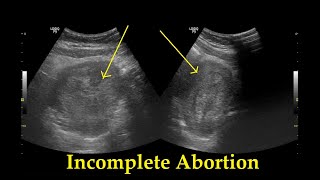 Incomplete Abortion  Ultrasound  Case 25 [upl. by Ana886]