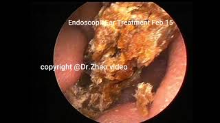 Previous review of Otoendoscopic cholesteatoma clearance 12 minutes [upl. by Asenaj]