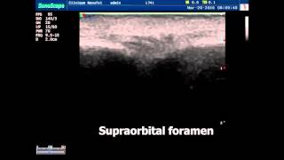 Ultrasound guided supraorbital nerve block Face block [upl. by Picardi660]