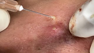 Big Cystic Acne Blackheads Extraction Blackheads amp Milia Whiteheads Removal Pimple Popping [upl. by Nosille]