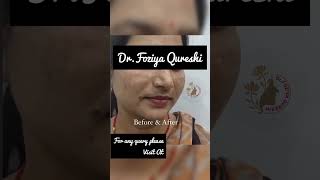 TREATMENT FOR MELASMA DRFOZIYA QURESHI melasma pigmentation shorts viral [upl. by Epperson]