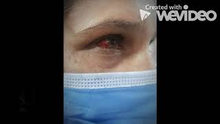 Eye Health Care Video quotOcular DD Talksquot DrSana Naseem OD Discussion on Subconjuctival hemorrhage [upl. by Esinal618]