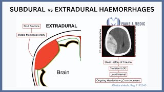 Subdural vs Extradural Haemorrhages Explained [upl. by Ettolrahs202]