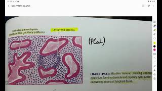 SALIVARY GLAND TUMOR 3 । MORPHOLOGY OF PLEOMORPHIC ADENOMA WARTHIN TUMOR PATHOLOGY । SAQ [upl. by Enehpets26]