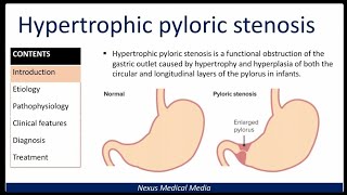 Hypertrophic Pyloric stenosis [upl. by Ainorev]