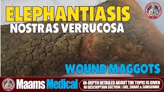 Elephantiasis Nostras Verrucosa and Wound Maggots  Rare Skin Disease [upl. by Ociredef]