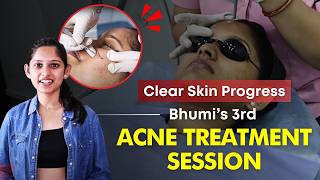 Acne Treatment का 3rd Session  Bhumis Acne Treatment Journey Continues  Clear Skin Pune [upl. by Lunseth450]