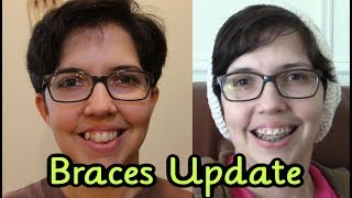 Adult Braces Update Month 14 [upl. by Intruoc462]