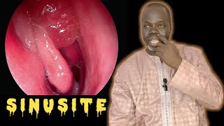 La sinusite 1  Symptômes et Causes  Pr Ousmane Ndiaye  SAMA XALAAT TV [upl. by Jaunita]