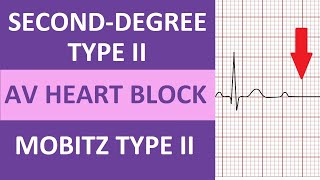 SecondDegree Type 2 Heart Block ECG Rhythm Nursing NCLEX  Mobitz Type II [upl. by Mitzl946]