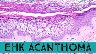 quotEHKomaquot epidermolytic hyperkeratotic acanthoma  solitary lesion of epidermolytic hyperkeratosis [upl. by Lehcor]