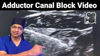 ADDUCTOR CANAL BLOCK Ultrasound Video  Saphenous nerve amp Nerve to Vastus Medialis  NVM Block [upl. by Devy]