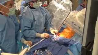 CoreValve Procedure I El Camino Hospital [upl. by Yeltneb]