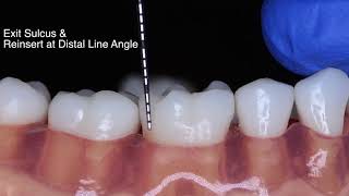 Periodontal Probe Basic Technique [upl. by Denice]