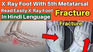 5th metatarsal fracture  Read Easily XRay Foot in hindi [upl. by Anomer428]