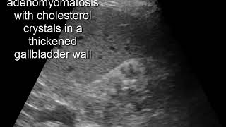 CASE 320 adenomyomatosis with cholesterol crystals in a thickened gallbladder wall [upl. by Anileuqcaj]