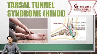 Tarsal Tunnel syndrome Hindi [upl. by Llertram381]