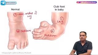 Club Foot  Congenital talipes equinovarus Hindi  Orthopedic Lectures [upl. by Erich]