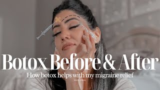 Botox Injection Before and After amp How It Helps my Migraine  By Sarv [upl. by Bonns]