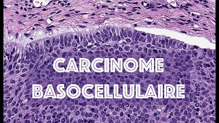 LE CARCINOME BASOCELLULAIRE  PATHOLOGIE [upl. by Dolly]