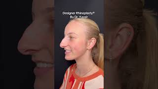 Nose Job Transformation 🤩 nosejobnyc nycplasticsurgeon njplasticsurgeon nycnosejob njnosejob [upl. by Gerfen]