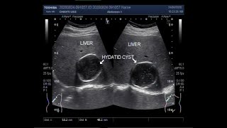 Ultrasound Video showing Hepatic Hydatid Cyst and Uterine Hemangioma Two Videos [upl. by Erline]