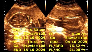 Routine antenatal ultrasound at 21 weeks gestation  Ultrasonography of a 21week pregnancy [upl. by Isobel969]