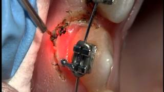 AMD Laser  Gingivectomy around brackets with Picasso [upl. by Cirederf]