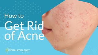 Acne Treatment  Explained by Dermatologist [upl. by Ajax]