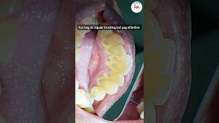 Is dental scaling harmful dentalscaling toothcleaning [upl. by Clements]