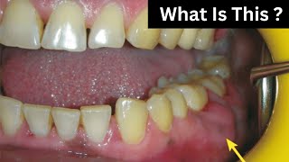 Dental Abscess  PERIODONTAL ABSCESS   Causes And Symptoms [upl. by Fayina579]