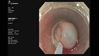 食道肌瘤切除術 Esophageal EMR Endoscopic Mucosal Resection  for leiomyoma [upl. by Einafats177]