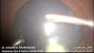 Anterior Chamber Silicon oil removal iridectomy [upl. by Neeruan]