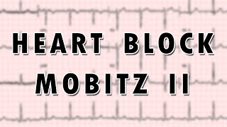 SecondDegree AV Heart Block Mobitz Type II [upl. by Suoicul]