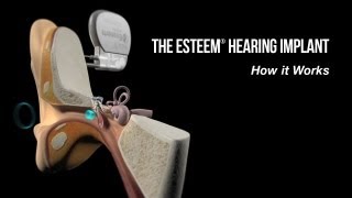 How Does the Esteem® Hearing Implant Differ From Hearing Aids [upl. by Ennaeel]