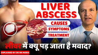 Minimally Invasive Treatment for Liver Abscess Catheter Drainage with Ultrasound [upl. by Carita811]