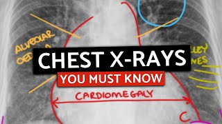 10 MUST KNOW Chest XRays For MedicalPA Finals  CXRs Made Easy [upl. by Gussy779]