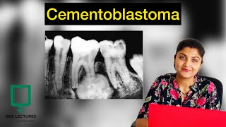 Cementoblastoma  Odontogenic Tumour  Lecture  24  Oral Pathology [upl. by Julio]