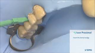 Icon Proximal  Caries Infiltration StepByStep with Dr Augusto Robles [upl. by Bust]