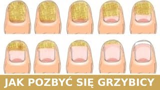 Jak Pozbyć Się Grzybicy Szybko i Naturalnie [upl. by Mcloughlin]