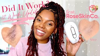 Did IPL work on brown skin 12 Week Update ft RoseSkinCo Lumi Device  IPL Journey [upl. by Atirahc]