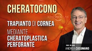 Cheratocono e trapianto di cornea cheratoplastica perforante [upl. by Onaicilef134]