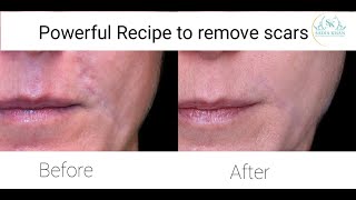 Powerful Recipe to remove scars from your skin permanently🤫 [upl. by Rosina500]