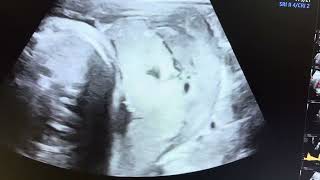 Ultrasound of Placental abruption [upl. by Aimar578]