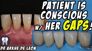 Closing The Patients Gaps with Direct Composite Technique C24 [upl. by Enilesor]