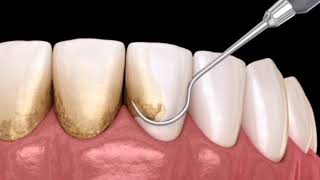 Detartraje subgingival y supragingival [upl. by Nyraa434]